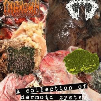 Carcinomas Of Unknown Primary Origin : A Collection of Dermoid Cysts